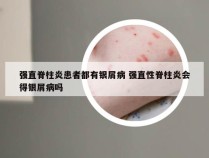 强直脊柱炎患者都有银屑病 强直性脊柱炎会得银屑病吗