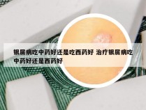 银屑病吃中药好还是吃西药好 治疗银屑病吃中药好还是西药好