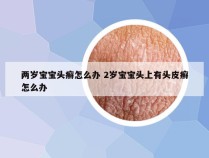 两岁宝宝头癣怎么办 2岁宝宝头上有头皮癣怎么办