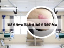 银宵癣用什么药比较好 治疗银霄癣的办法