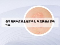 备孕期间牛皮癣全身影响么 牛皮肤癣会影响怀孕