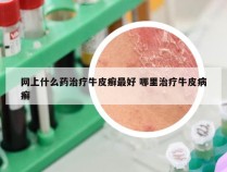 网上什么药治疗牛皮癣最好 哪里治疗牛皮病癣