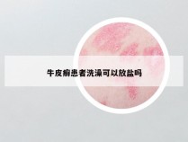 牛皮癣患者洗澡可以放盐吗