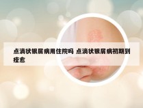 点滴状银屑病用住院吗 点滴状银屑病初期到痊愈