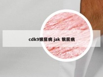 cdk9银屑病 jak 银屑病