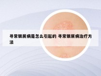 寻常银屑病是怎么引起的 寻常银屑病治疗方法