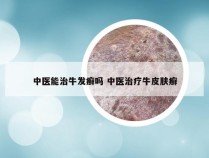 中医能治牛发癣吗 中医治疗牛皮肤癣