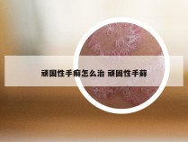 顽国性手癣怎么治 顽固性手藓