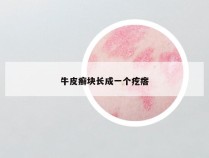 牛皮癣块长成一个疙瘩