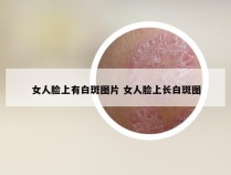 女人脸上有白斑图片 女人脸上长白斑图