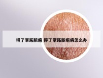 得了掌跖脓疱 得了掌跖脓疱病怎么办