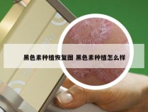 黑色素种植恢复图 黑色素种植怎么样