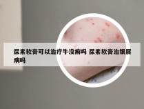 尿素软膏可以治疗牛没癣吗 尿素软膏治银屑病吗