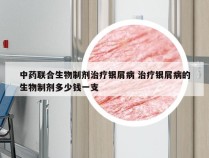 中药联合生物制剂治疗银屑病 治疗银屑病的生物制剂多少钱一支