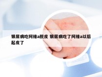 银屑病吃阿维a脱皮 银屑病吃了阿维a以后起皮了