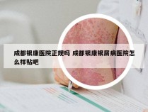 成都银康医院正规吗 成都银康银屑病医院怎么样贴吧