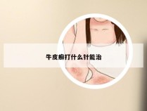 牛皮癣打什么针能治