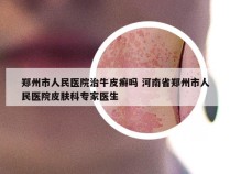 郑州市人民医院治牛皮癣吗 河南省郑州市人民医院皮肤科专家医生