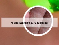 头皮癣传染给家人吗 头皮癣传染?