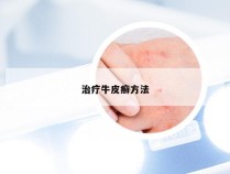 治疗牛皮癣方法