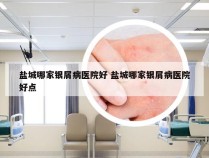 盐城哪家银屑病医院好 盐城哪家银屑病医院好点