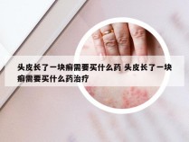 头皮长了一块癣需要买什么药 头皮长了一块癣需要买什么药治疗