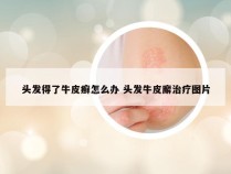 头发得了牛皮癣怎么办 头发牛皮廨治疗图片