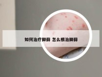 如何治疗脚藓 怎么根治脚藓