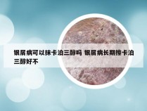 银屑病可以抹卡泊三醇吗 银屑病长期擦卡泊三醇好不