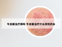 牛皮廨治疗痒吗 牛皮廨治疗什么特效药水