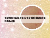 银屑病会引起脚底痛吗 银屑病会引起脚底痛吗怎么治疗