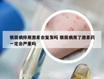 银屑病停用激素会复发吗 银屑病用了激素药一定会严重吗