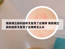 银屑病之前的旧疹又复发了还瘙痒 银屑病之前的旧疹又复发了还瘙痒怎么办