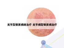 关节型银屑病胡治疗 关节病型银屑病治疗