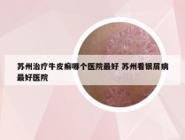 苏州治疗牛皮癣哪个医院最好 苏州看银屑病最好医院