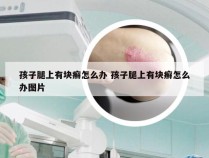 孩子腿上有块癣怎么办 孩子腿上有块癣怎么办图片