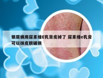 银屑病用尿素维E乳膏皮掉了 尿素维e乳膏可以抹皮肤破损