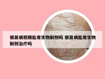 银屑病初期能用生物制剂吗 银屑病能用生物制剂治疗吗