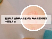 重度红皮病和银穴病怎样治 红皮病型银屑治疗最好方法