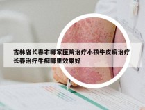 吉林省长春市哪家医院治疗小孩牛皮癣治疗 长春治疗牛癣哪里效果好