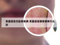 真菌感染引起银屑病 真菌感染银屑病用什么药