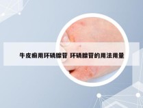 牛皮癣用环磷腺苷 环磷腺苷的用法用量