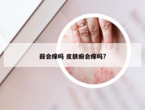 藓会痒吗 皮肤癣会痒吗?