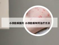 小孩脸癣图片 小孩脸癣如何治疗方法