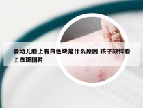 婴幼儿脸上有白色块是什么原因 孩子缺锌脸上白斑图片