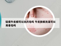 轻度牛皮癣可以洗药皂吗 牛皮肤癣洗澡可以用香皂吗