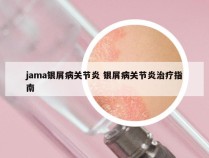 jama银屑病关节炎 银屑病关节炎治疗指南