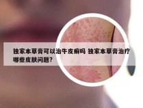 独家本草膏可以治牛皮癣吗 独家本草膏治疗哪些皮肤问题?