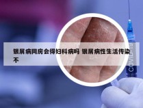 银屑病同房会得妇科病吗 银屑病性生活传染不