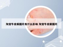 淘宝牛皮癣图片有什么影响 淘宝牛皮廨图片